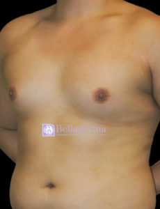 Gynecomastia Before and After Pictures San Diego, CA