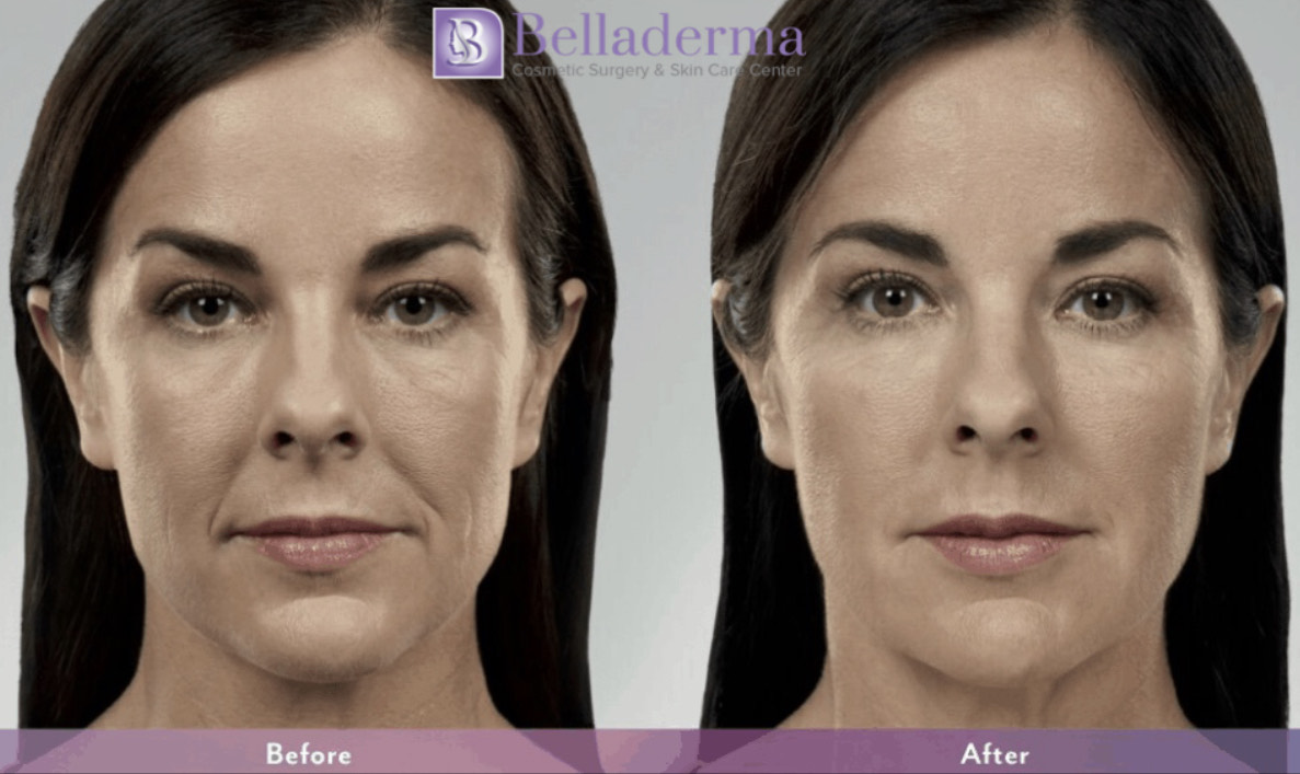 Juvederm® in San Diego, CA