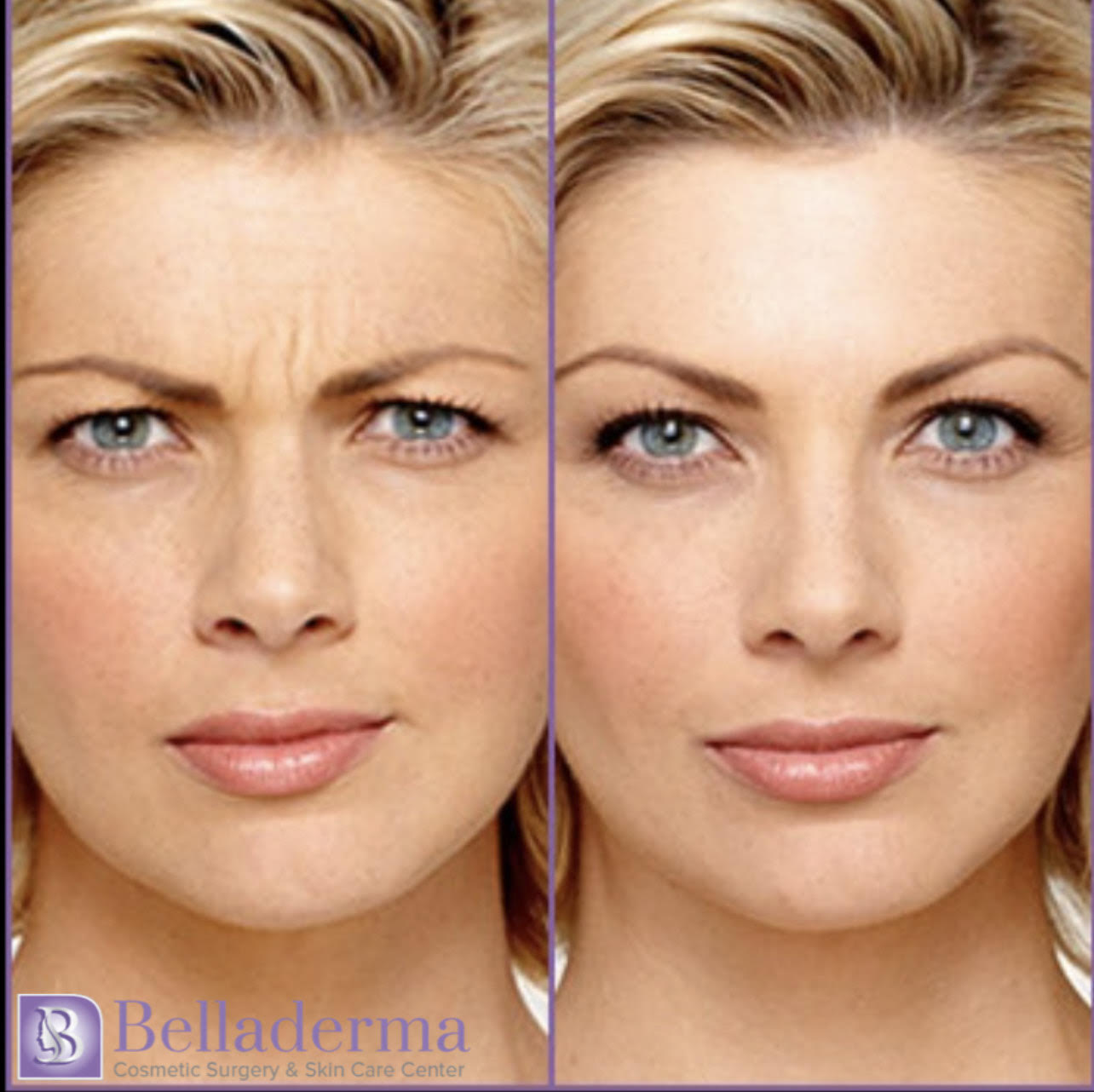 Botox® in San Diego, CA