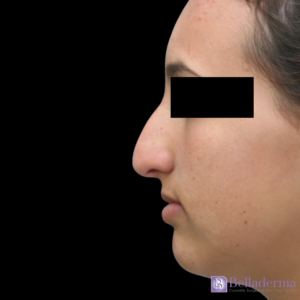 Rhinoplasty Before and After Pictures San Diego, CA