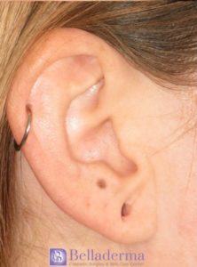Earlobe Repair Before and After Pictures San Diego, CA