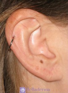 Earlobe Repair Before and After Pictures San Diego, CA