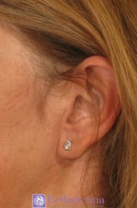 Earlobe Repair Before and After Pictures San Diego, CA