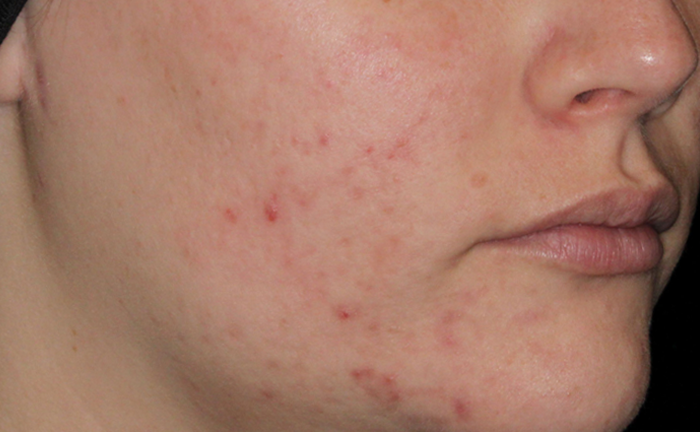 Acne Treatments in San Diego, CA