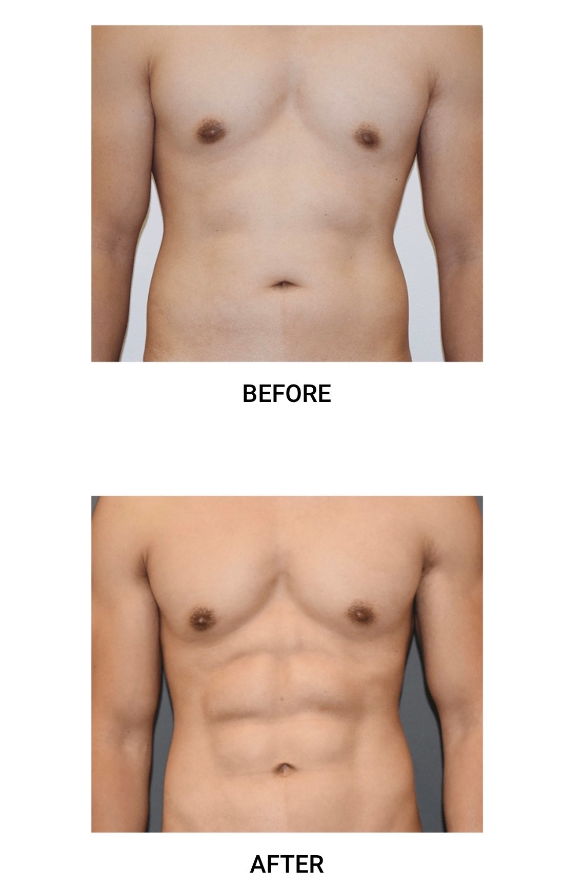 VASER Liposuction