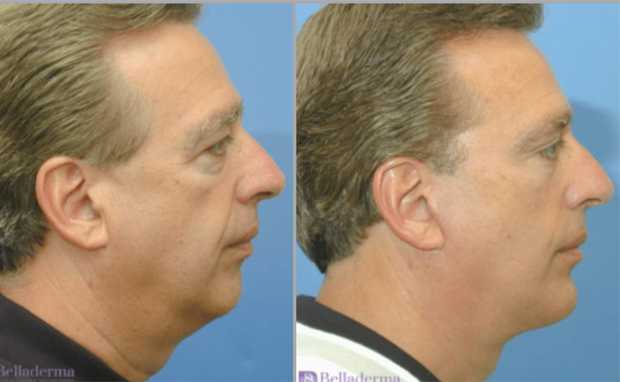 Chin Augmentation Before and After Pictures San Diego, CA