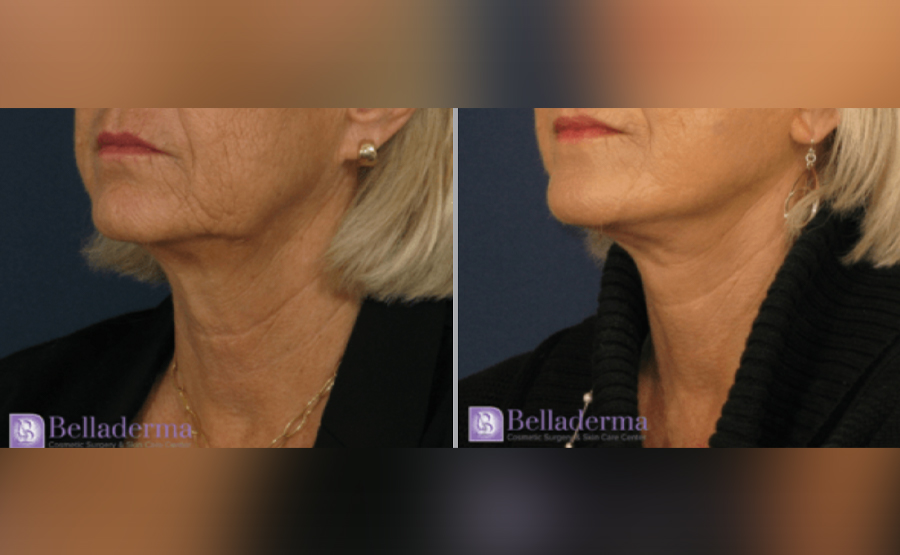 Neck lift Before and After Pictures San Diego, CA
