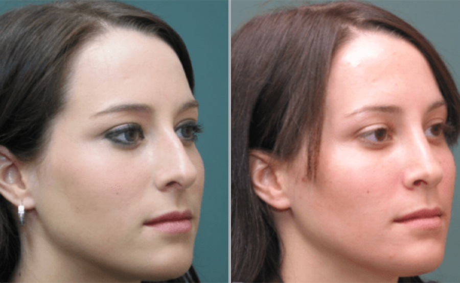 Rhinoplasty Before and After Pictures San Diego, CA