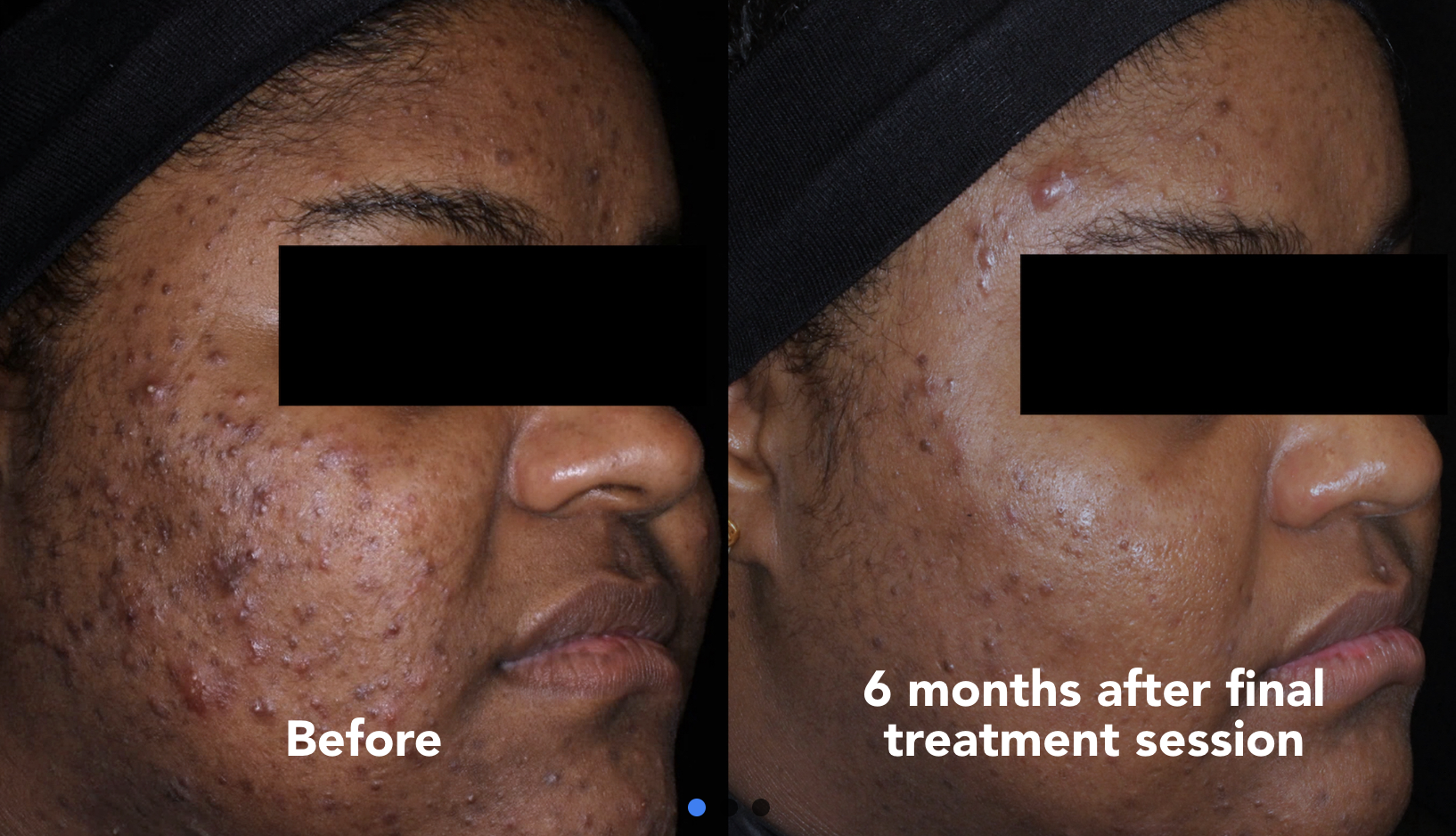 Acne Treatments in San Diego, CA