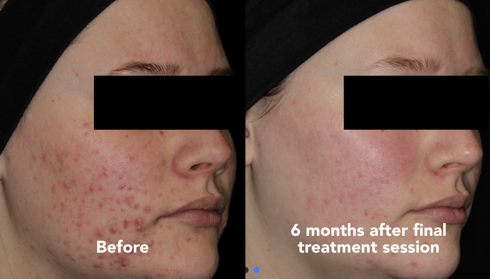 Acne Treatments in San Diego, CA