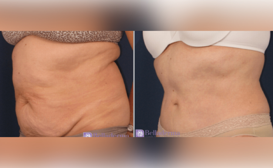 Tummy Tuck Before and After Pictures San Diego, CA