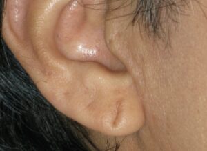Earlobe Repair Before and After Pictures San Diego, CA