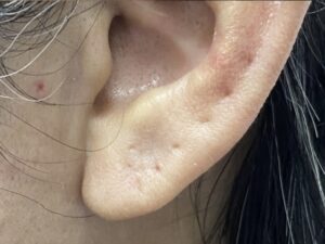 Earlobe Repair Before and After Pictures San Diego, CA