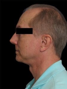Men Rhinoplasty Before and After Pictures San Diego, CA