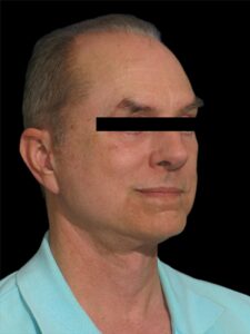 Men Rhinoplasty Before and After Pictures San Diego, CA