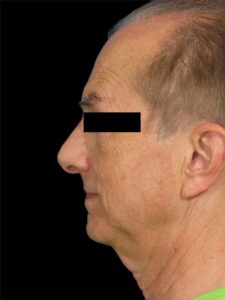 Men Rhinoplasty Before and After Pictures San Diego, CA