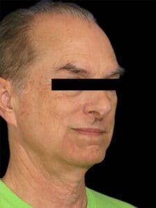 Men Rhinoplasty Before and After Pictures San Diego, CA