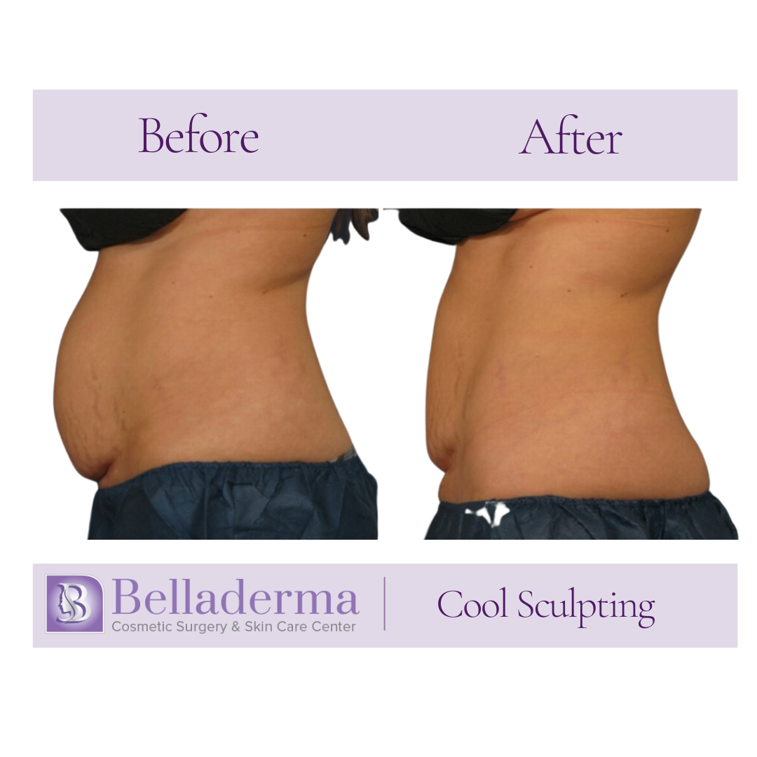 Coolsculpting Before  and After