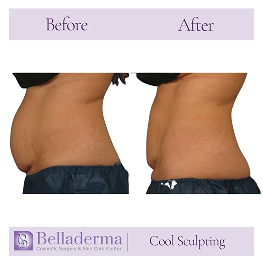 CoolSculpting®