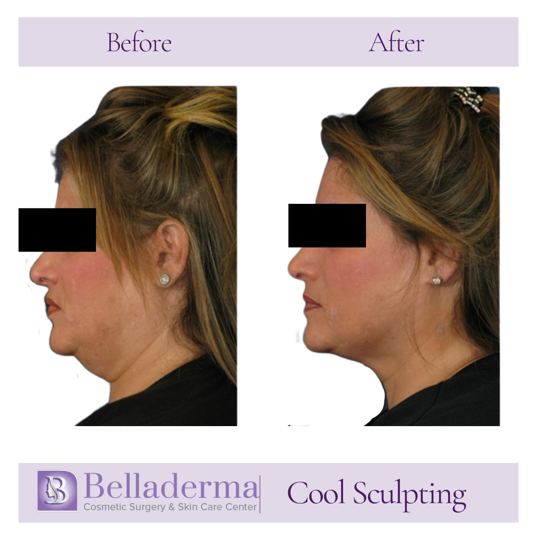 Coolsculpting Before  and After