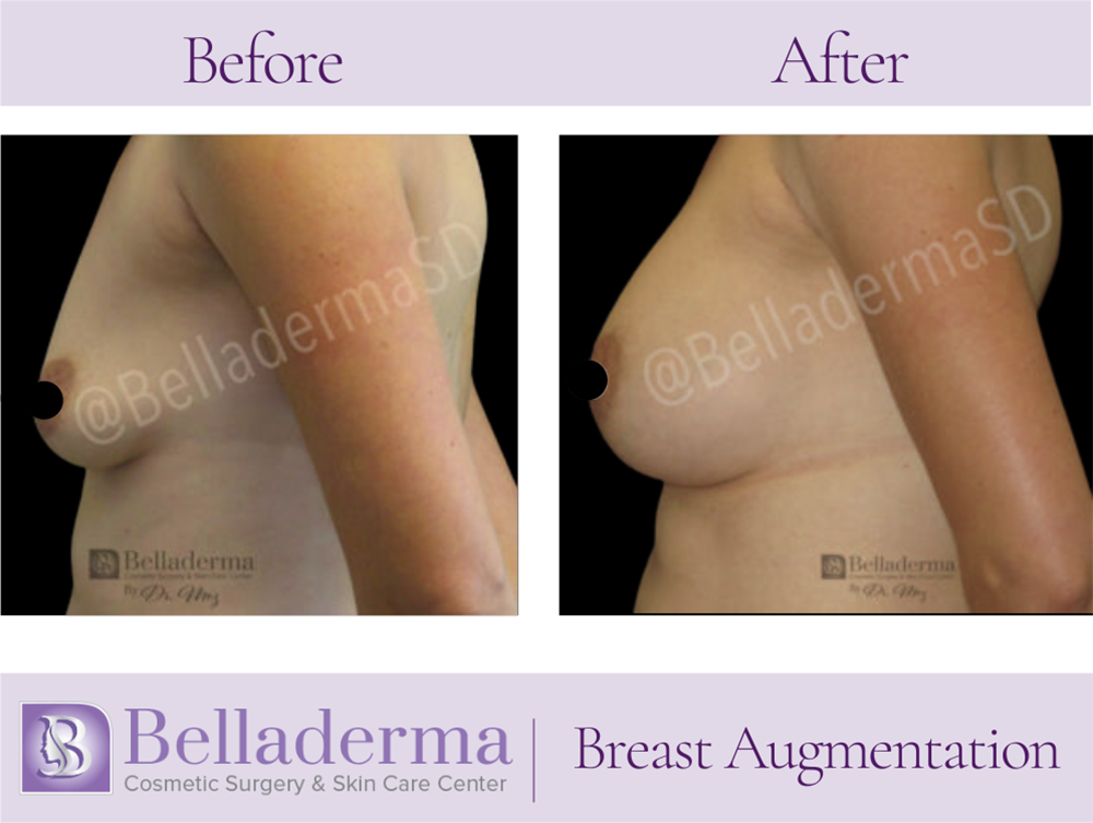 Breast Augmentation Before and After