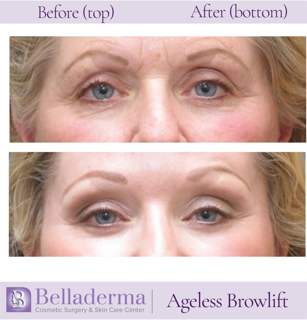 Brow Lift and Eyelid Lift Before and After