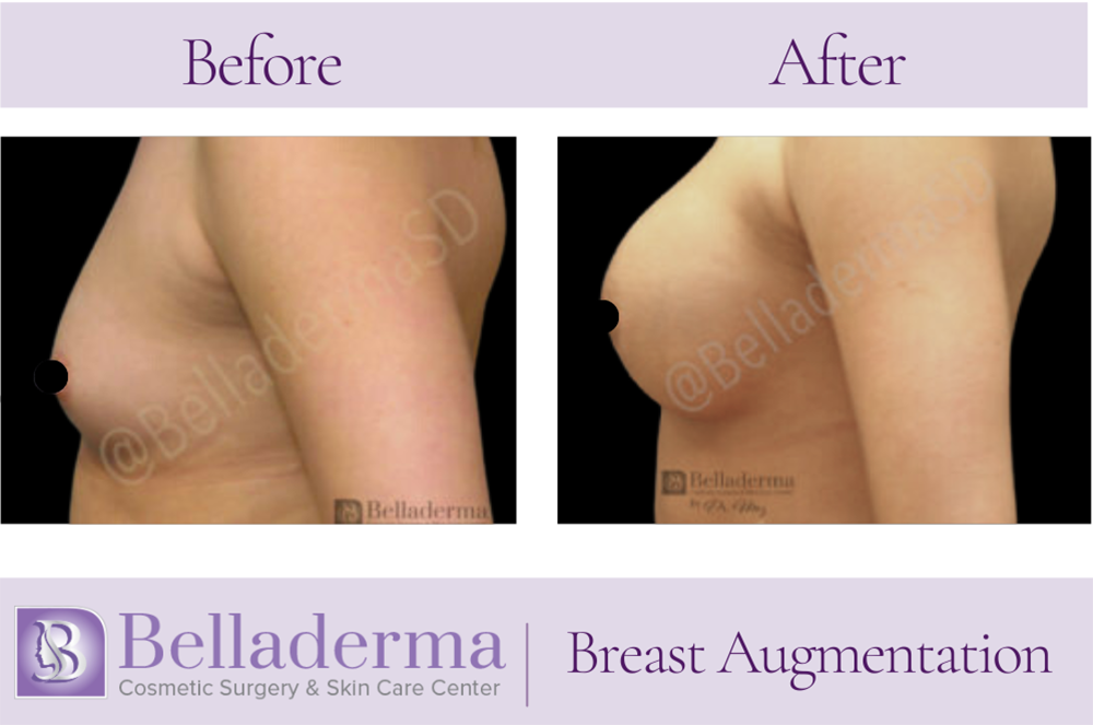 Breast Augmentation Before and After