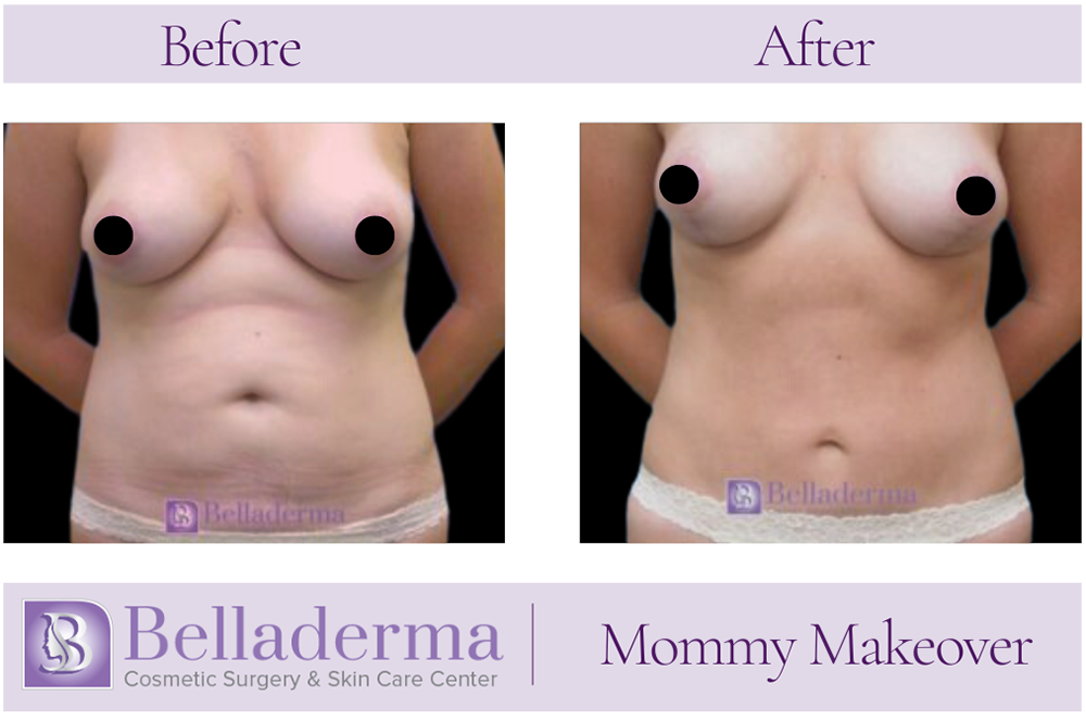1 (2) Mommy Makeover Before and After