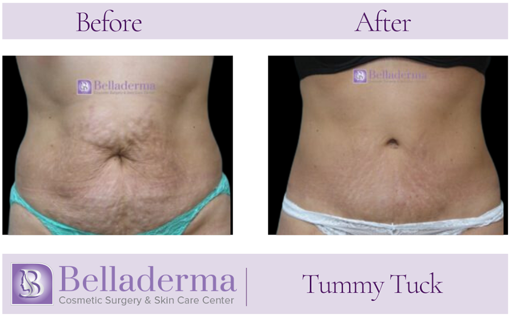 1 (2) Tummy Tuck (abdominoplasty) Before and After