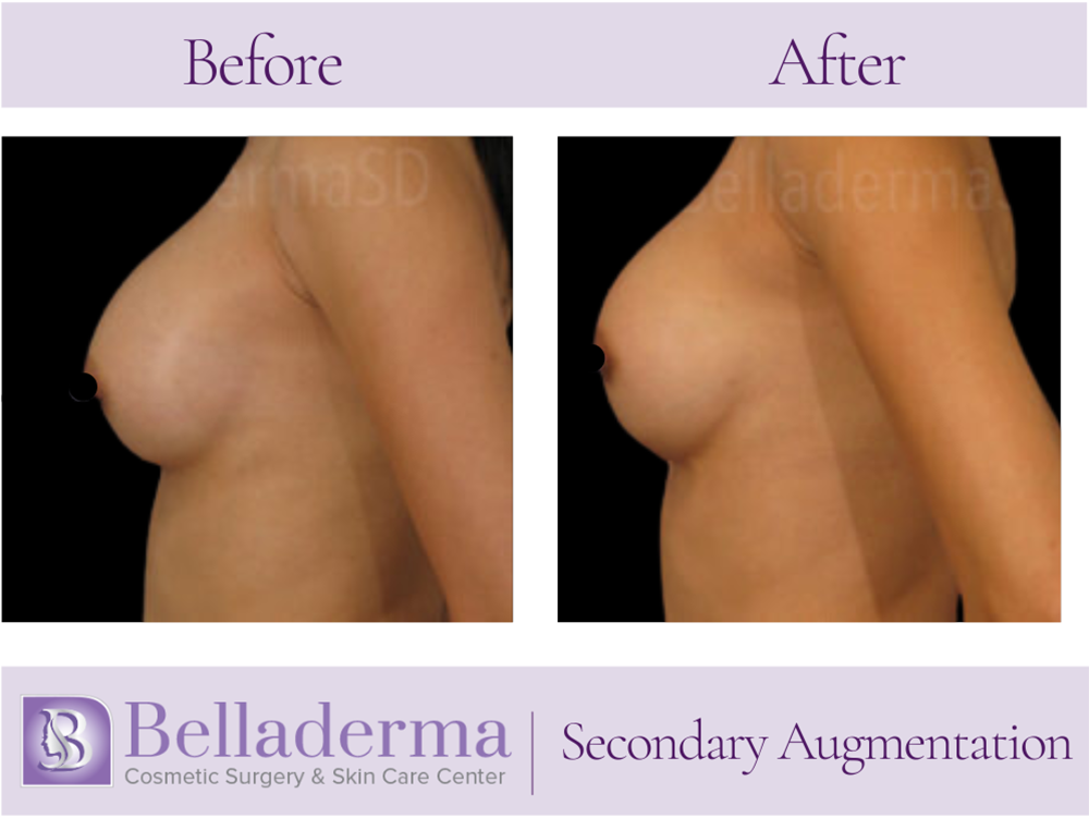 Breast Augmentation Before and After