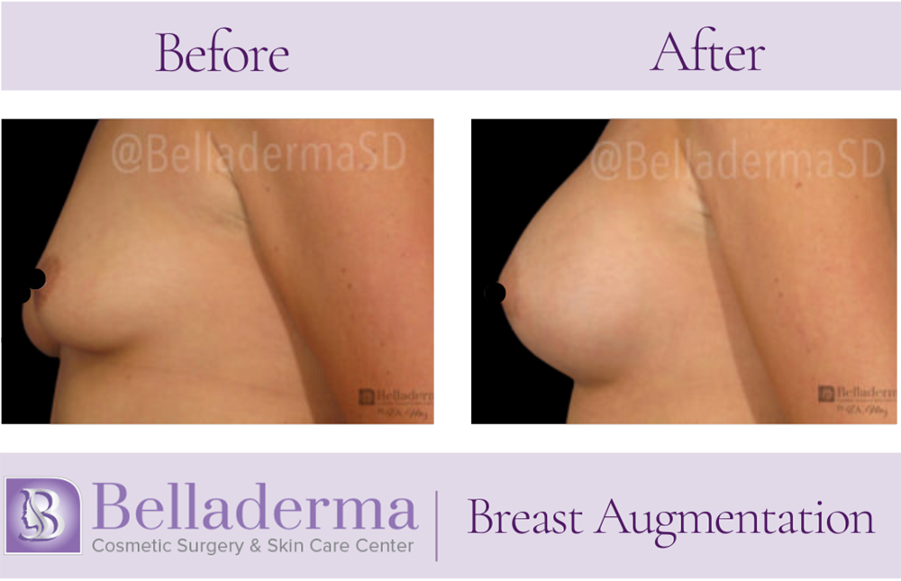 Breast Augmentation Before and After