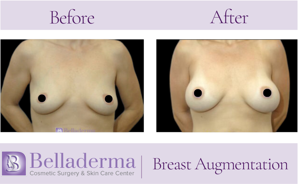 Breast Augmentation Before and After