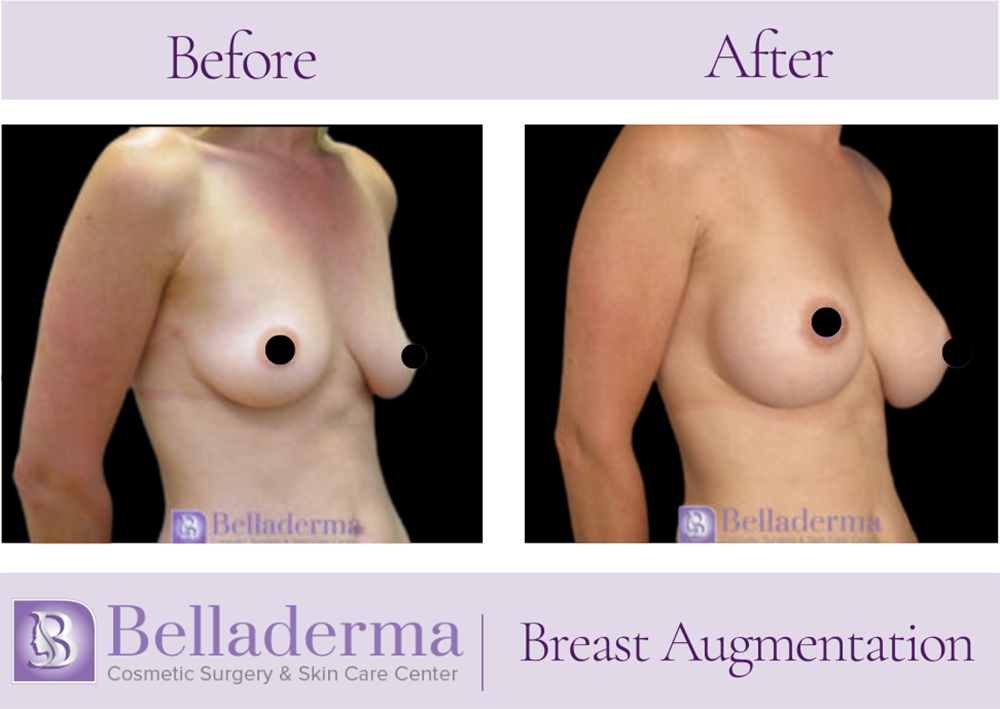 Breast Augmentation Before and After