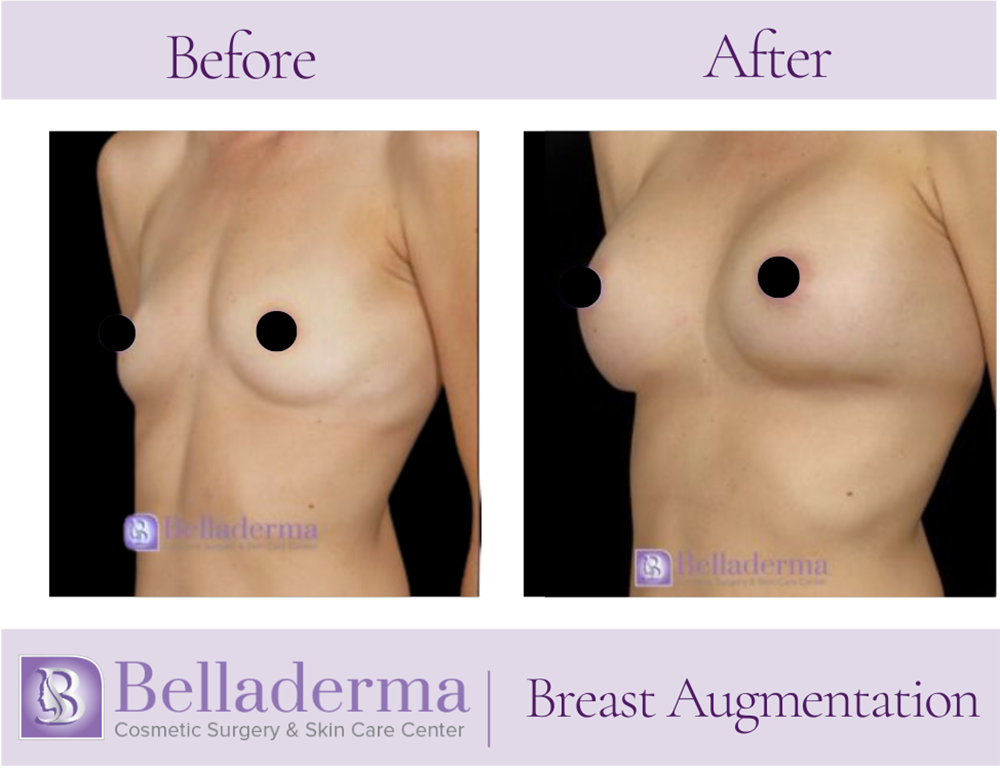 Breast Augmentation Before and After