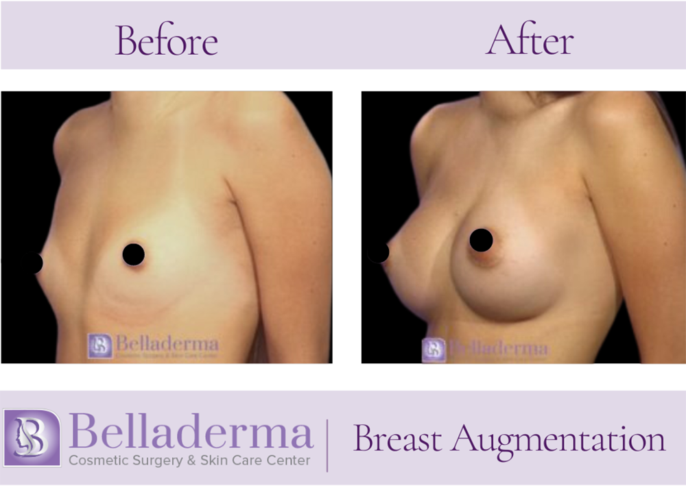 Breast Augmentation Before and After