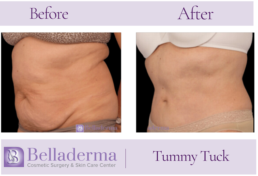 Tummy Tuck (abdominoplasty) Before and After