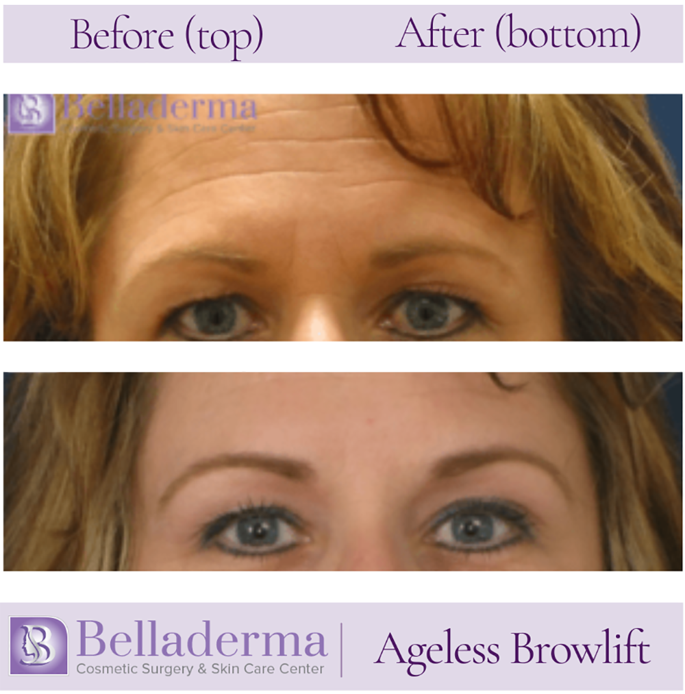 Brow Lift and Eyelid Lift Before and After