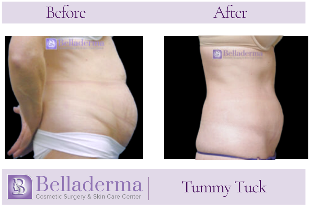 Tummy Tuck (abdominoplasty) Before and After