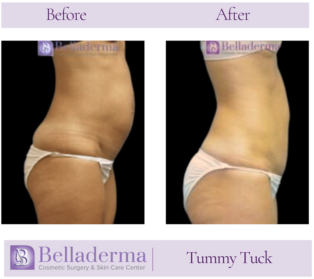 Tummy Tuck (abdominoplasty) Before and After