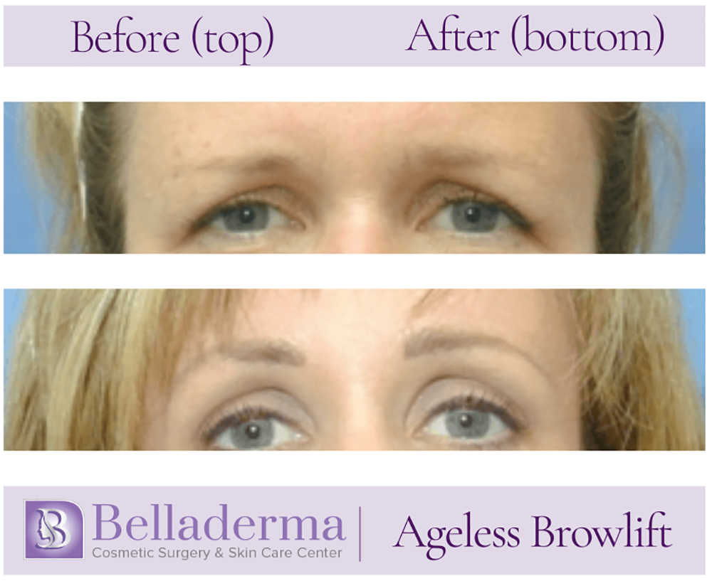 Brow Lift and Eyelid Lift Before and After