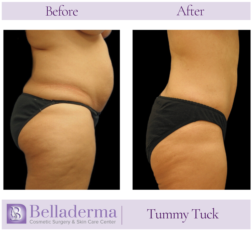 Tummy Tuck (abdominoplasty) Before and After