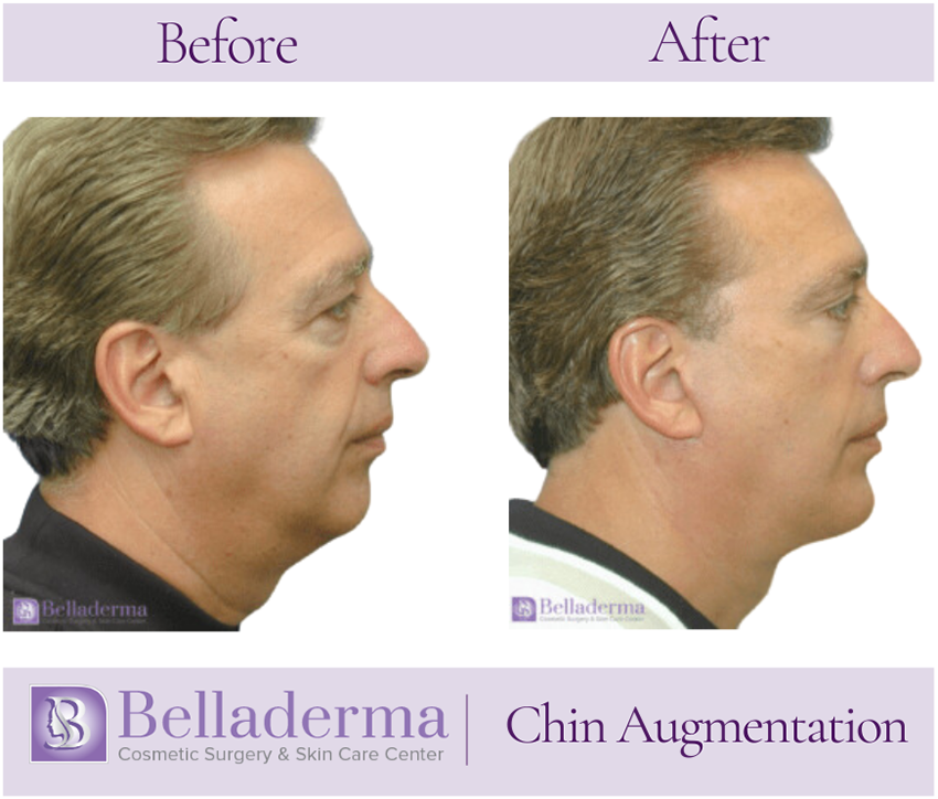 Chin Augmentation Before and After