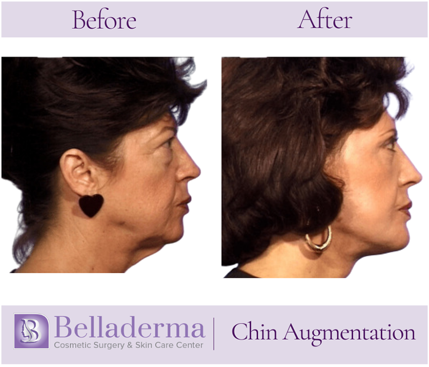 Chin Augmentation Before and After
