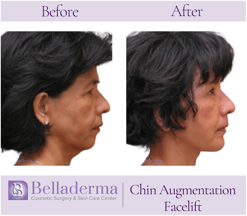 Chin Augmentation Before and After