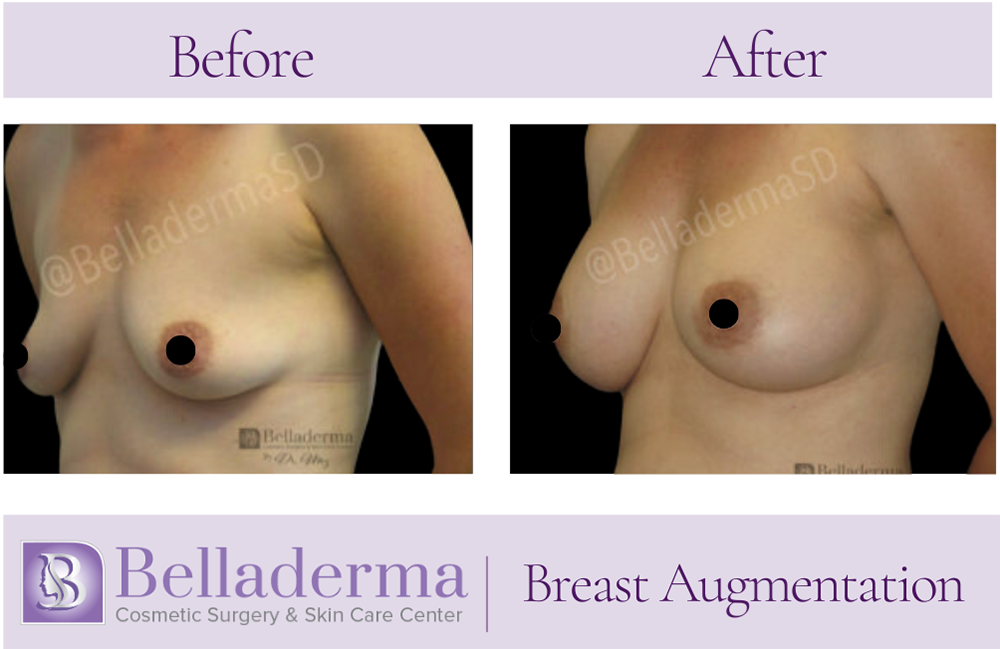 Breast Augmentation Before and After