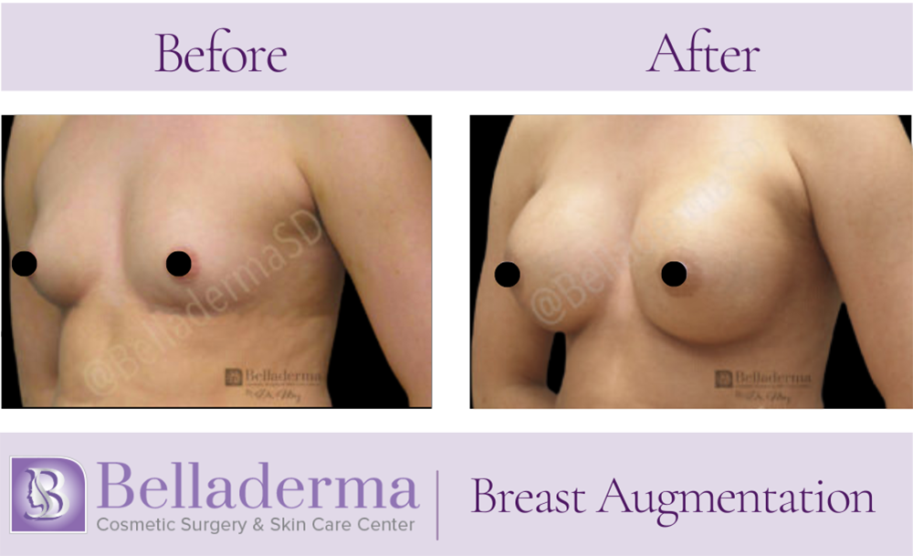 Breast Augmentation Before and After