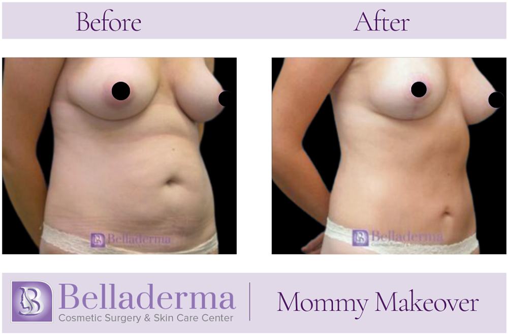 2 (2) Mommy Makeover Before and After