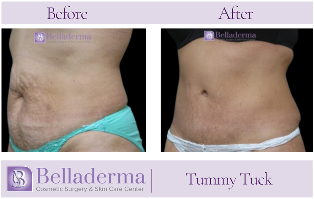 2 (2) Tummy Tuck (abdominoplasty) Before and After