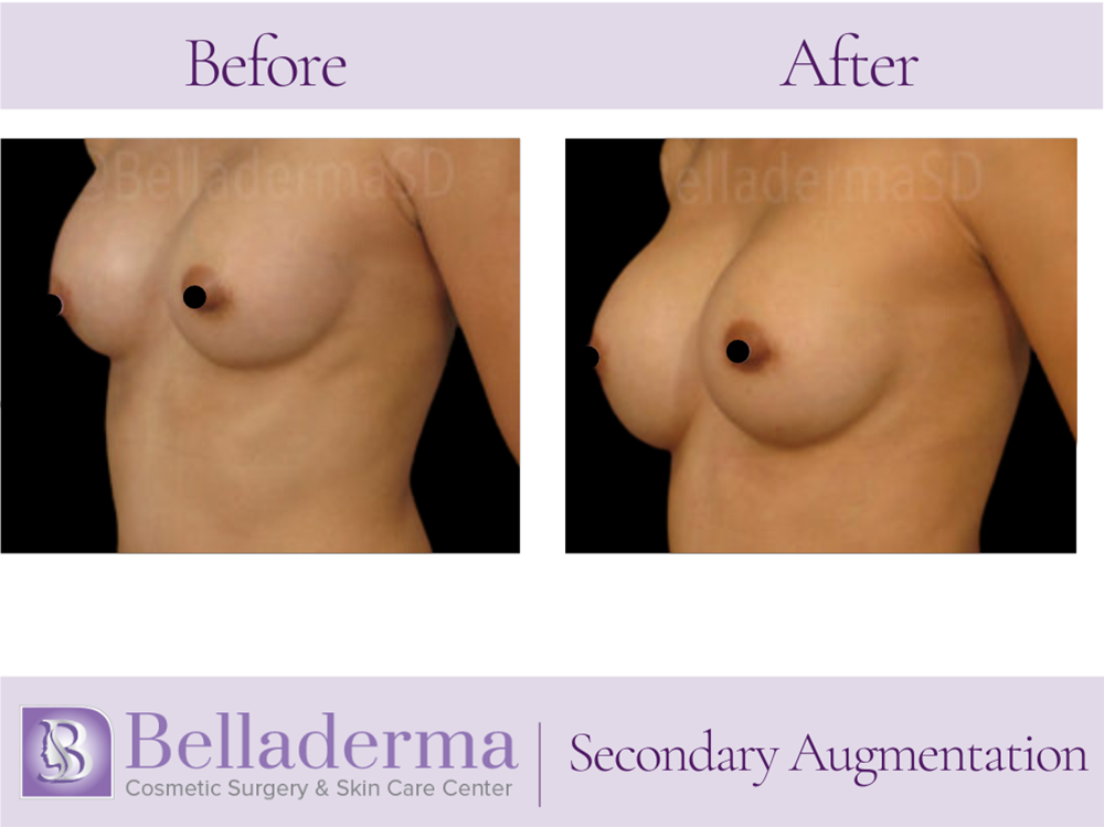 Breast Augmentation Before and After