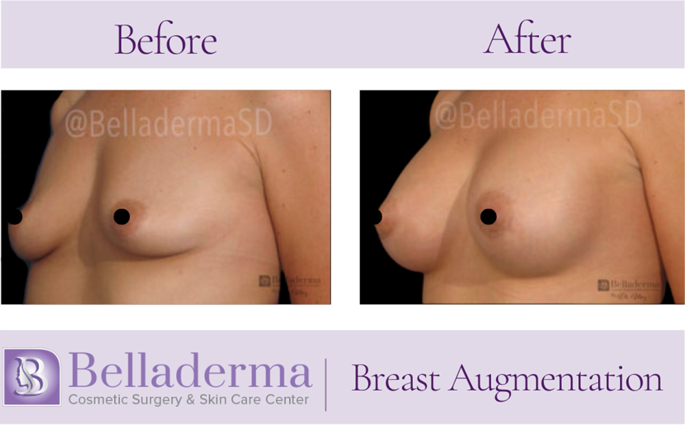 Breast Augmentation Before and After